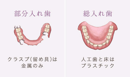 <部分入れ歯>クラスプ(留め具)は金属のみ <総入れ歯>人口歯と床はプラスチック