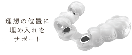 理想の位置に埋め入れをサポート