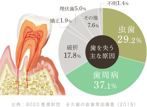 出典:8020推進財団 永久歯の抜歯原因調査(2018)