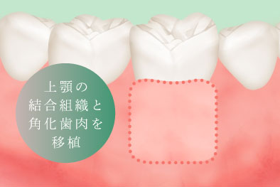 上顎の結合組織と角化歯肉を移植