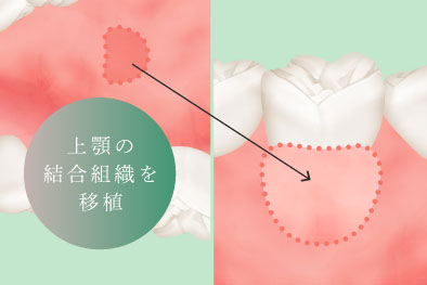 上顎の結合組織を移植
