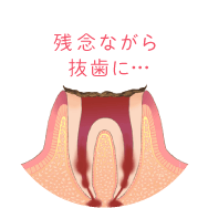 残念ながら抜歯に