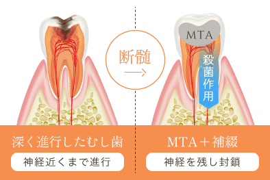 深く進行したむし歯(神経近くまで進行)を断髄 MTA+補綴(神経を残し封鎖)